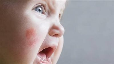 أسباب ظهور حساسية الجلد عند الأطفال