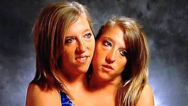 What Conjoined Twins Abby And Brittany Hensel Look Like Now