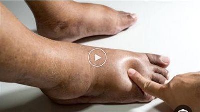 ما هي أضرار احتباس السوائل في الجسم ؟ وكيفية الوقاية منه ؟
