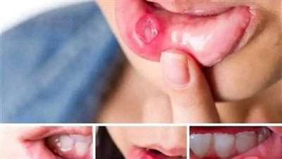 افضل علاج لتقرحات الفم