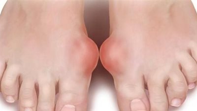 أسباب مرض النقرس