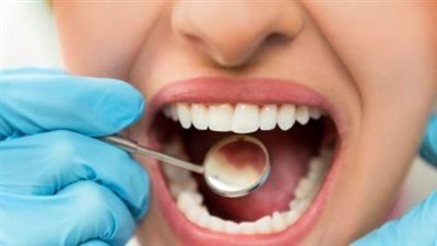 تسوس الأسنان : الأعراض، الأسباب، وطرق العلاج
