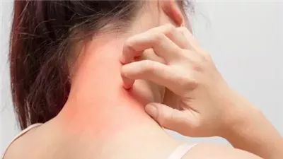 10 من أهم الطرق الطبية والطبيعية لعلاج الإكزيما