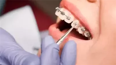 تقويم الأسنان : تقويم ابتسامتك وتحسين صحة الفم