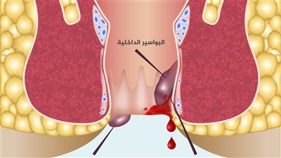 علاج البواسير في يوم واحد سواء كانت خارجية او داخلية
