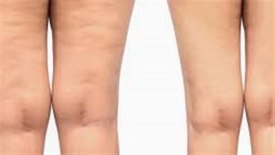أسباب ترهل الجسم وطرق علاجه