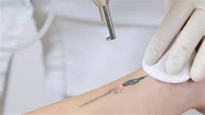 طرق إزالة الوشم بدون ليزر
