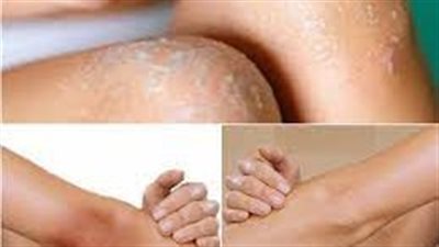 طرق إزالة سواد الركب والأكواع في المنزل