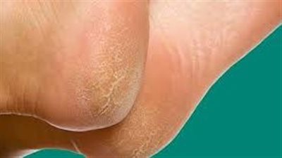 خلطات طبيعية للعناية بالقدمين