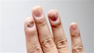 ما هي الأمراض التي تصيب الأظافر؟