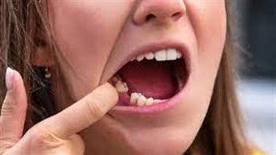 أنواع مضاعفات خلع الضرس