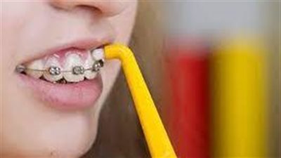كيفية تنظيف الأسنان مع التقويم: وداعاً للبلاك والترسبات!