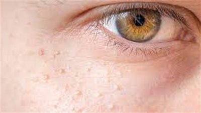  حلول طبيعية لجمال البشرة: طرق إزالة حبوب الوجه