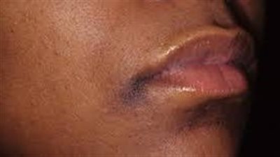 منتجات طبيعية لعلاج سواد الوجه