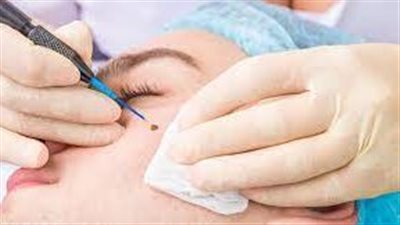 طرق إزالة الشامات من الوجه