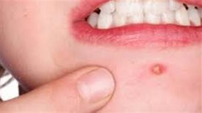 سبب ظهور الحبوب الحمراء في الوجه