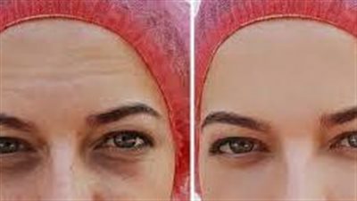 فوائد حقن الدهون في الوجه