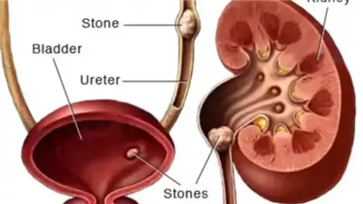 أعراض إذا ظهرت فقد تشير لوجود مشكلة صحيّة في كليتيك