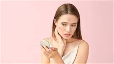 5 وصفات طبيعية سحرية لعلاج آثار حب الشباب في أسبوع