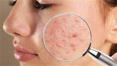 وداعاً للندبات: 3 خطوات ذهبية لمنع ظهور حب الشباب وعلاجه