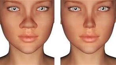 تجميل الأنف: حلول طبيعية لعيوب بسيطة