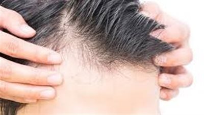 وداعاً للصلع: وصفات طبيعية لزيادة كثافة الشعر من الأمام