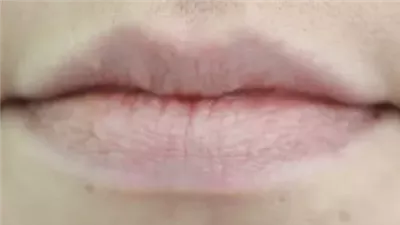 أعراض تظهر على الوجه عند وجود نقص في الفيتامينات