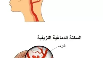 أنواع السكتات الدماغية