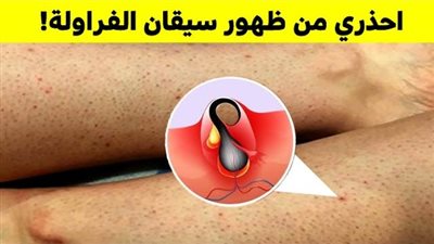 أفضل الطرق للتخلص من سيقان الفراولة