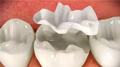 تعرف على أنواع حشوات الأسنان وإيجابيات وسلبيات كل نوع