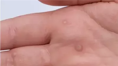 أكثر العلامات الجلدية شيوعاً وأسباب الإصابة بها وكيفية التعامل معها