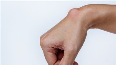 أعراض وأسباب ظهور النتوء في الرسغ