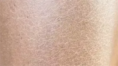 ما هي أسباب ظهور نتوء حمراء على البشرة ؟