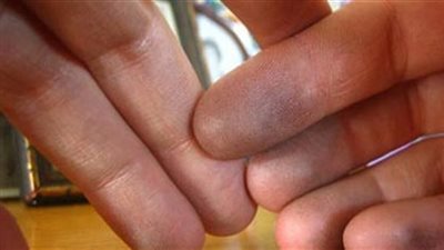 الټسمم بالړصاص: الأسباب والأعراض والعلاج