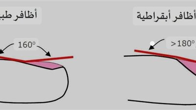 تبقرط الأصابع وتشمع الكبد - انتبهوا لشكل ولون الأظافر