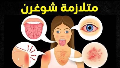 متلازمة شوغرن: الغموض وراء جفاف العين والفم وكيفية مواجهتها!