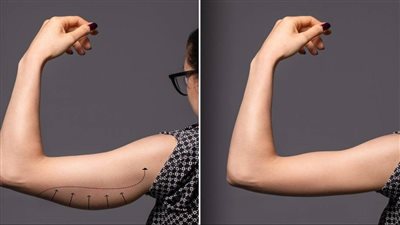 Arm Flab: Causes and Treatment