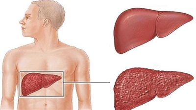 Hepatitis B