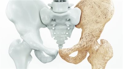 هشاشة العظام : فئات الأشخاص الأكثر عرضة والأعراض والعلاج