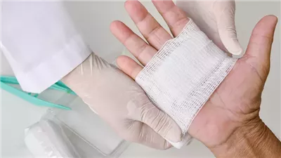 حـروق الجلد .. الإسعافات الأولية والعلاج