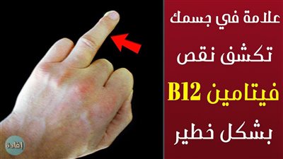 نقص فيتامين B12 : أعراضه وعلاجه