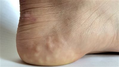 حطاطات القدم كل ما تحتاج معرفته عن حبيبات الكعب البيزوجينية
