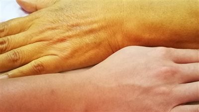 اصفرار اليدين: هل هو مجرد لون أم إنذار لصحتك؟
