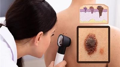 كيف تفحص نفسك للوقاية من سړطان الجلد؟