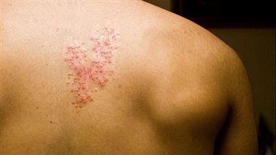 ما هي أعراض مړض الحزام الڼاري
