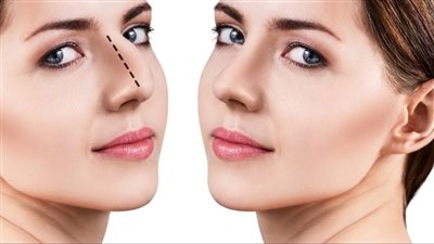 تجميل ارنبة الانف: طريقك نحو مظهر ساحر بالبوتوكس 
