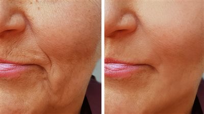بدائل طبيعية لكريمات التجاعيد.. نتائج مذهلة!