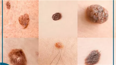 أطباء يكشفون: علامات تحذيرية مبكرة لسړطان الجلد