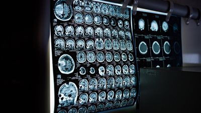 6 أعراض تحذيرية تشير إلى سړطان العظام