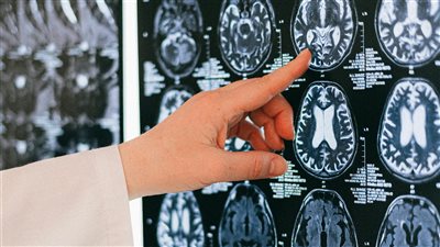 أعراض التصلب المتعدد قد تظهر قبل 15 عامًا من التشخيص والنساء غالبًا ما يتجاهلن العلامات المبكرة 